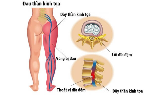 Cách phân biệt đau thần kinh tọa và hội chứng Piriformis