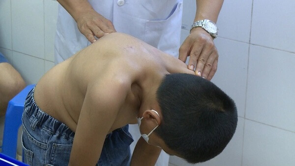 Ngồi học sai tư thế gây gù lưng và cách khắc phục